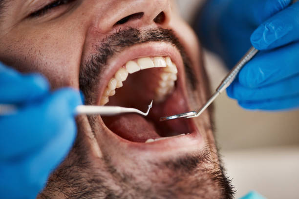 Best Knocked-Out Tooth (Avulsed Tooth) Treatment in Bloomingdale, NJ